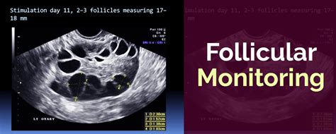 Follicular monitoring .